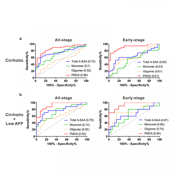 Acute-phase serum amyloid A for early detection of hepatocellular carcinoma in cirrhotic patients with low AFP level Acute-phase serum amyloid A for early detection of hepatocellular carcinoma in cirrhotic patients with low AFP level